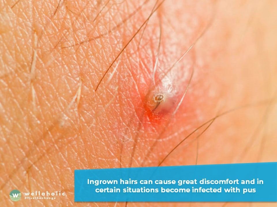 ingrown hairs can cause great discomfort